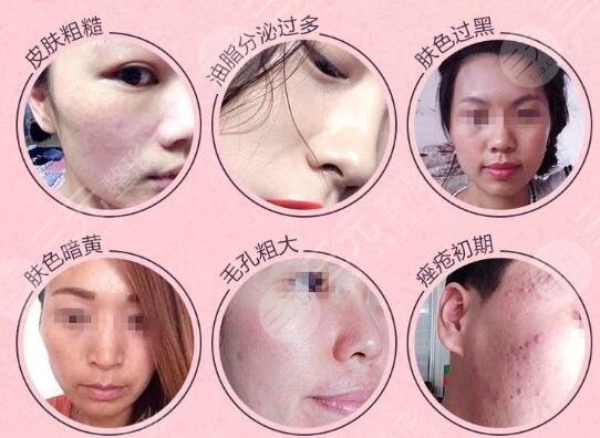 黑脸娃娃的缺点副作用