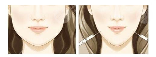 如何让咬肌变小？