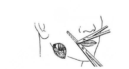 如何让咬肌变小？