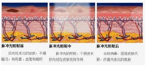 光子嫩肤术操作流程