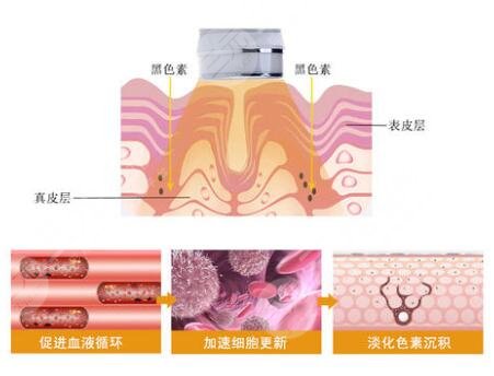 光子嫩肤缓解的特点