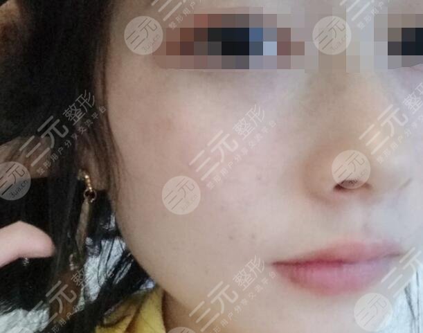 九江附属医院整形科激光祛斑后