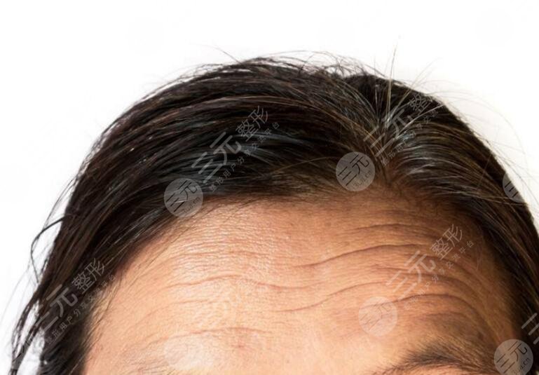激光除皱适合的人群