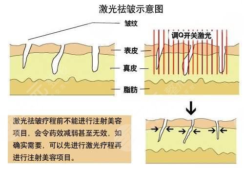 激光除皱原理解析