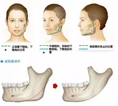 下颌骨手术有哪几种方式