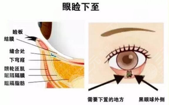 眼睑皮肤松弛矫正风险