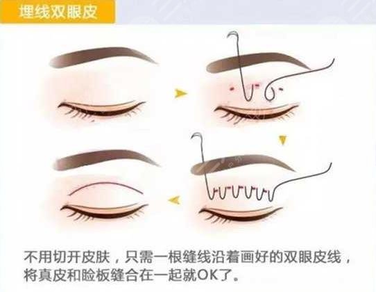 埋线双眼皮一到7天图片分享，附埋线双眼皮恢复图片过程