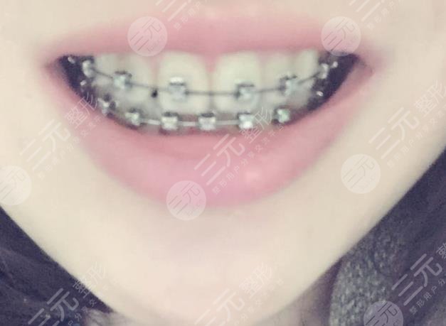浙江省口腔医院牙齿矫正经历分享