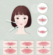 玻尿酸丰唇的果怎么样？小姐姐告诉你玻尿酸丰唇的优势