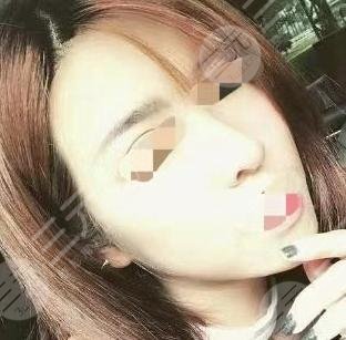 真实垫下巴后2个月