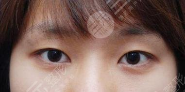 双眼皮整形前