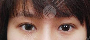 双眼皮整形后