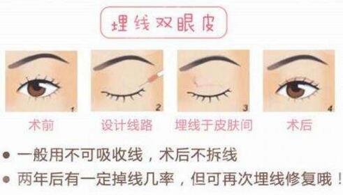 手术过程