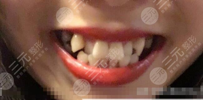 北京爵冠口腔医院牙齿矫正经历分享
