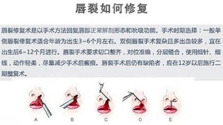 【唇裂修复术】整形科普：让你重获自信容颜！