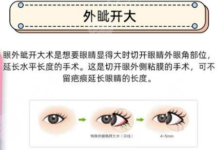 外眼角开大手术是什么，怎么做？超全科普分享，不做小白！
