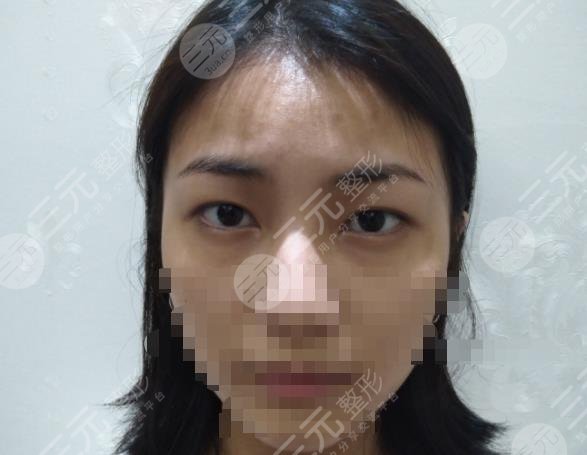 西京医院整形项目介绍及双眼皮手术经历分享