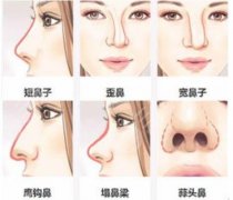 怎样做鼻子整形？手术科普超全解答，来pick属于你的方案吧！