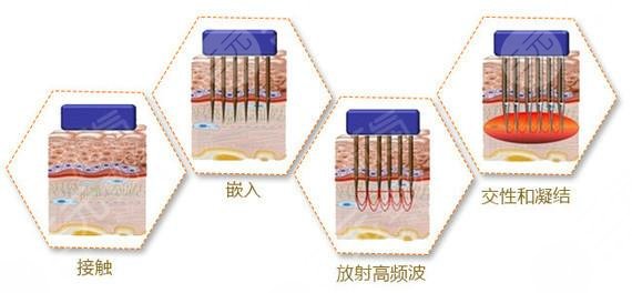 接受微针痘坑后需要注意什么