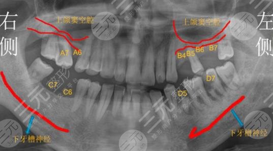 泰康拜博口腔医院种植牙分享