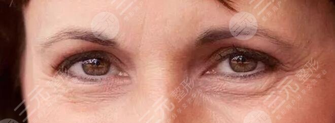 激光去鱼尾纹要多久