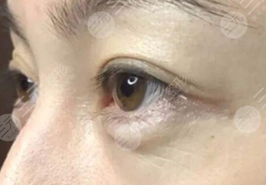 激光去鱼尾纹案例前