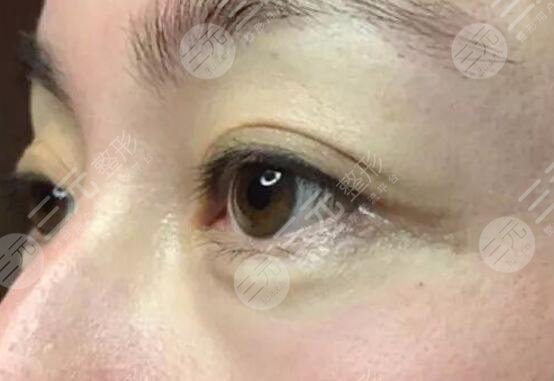 激光去鱼尾纹案例后