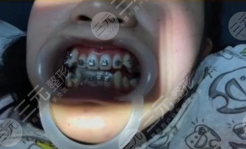 楚雄庞氏牙科牙齿矫正经历分享