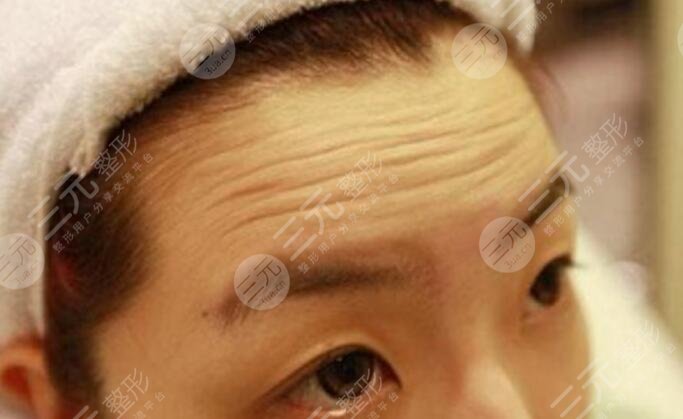 去抬头纹大概要多少钱？深知4个原因影响了手术的价格！