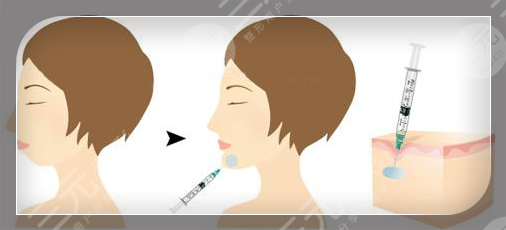 玻尿酸垫下巴维持多久