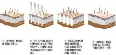 像素激光去痘疤需要注意什么？优点&术后护理超全科普！