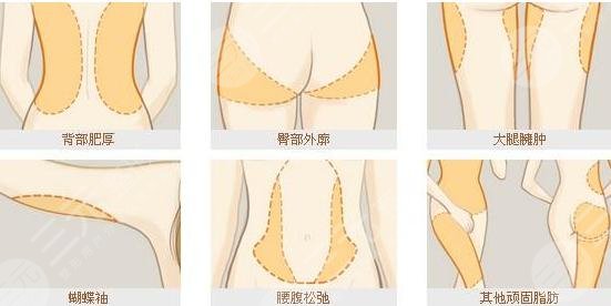 镭射溶脂