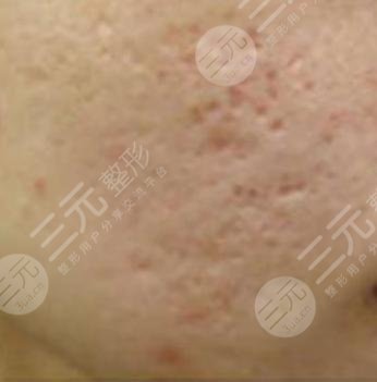 像素激光去除青春痘4个注意事项