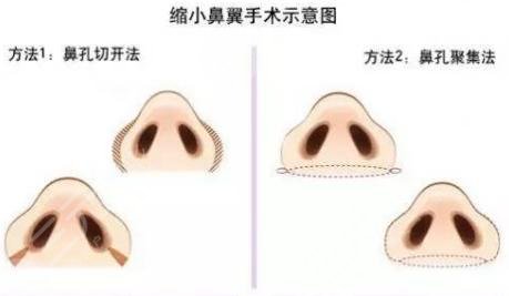 什么是鼻头缩小术