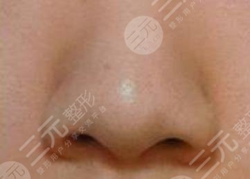 鼻头缩小手术价钱具体是多少？