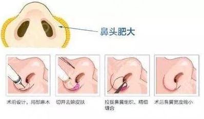 鼻头缩小能保持多久