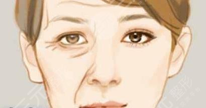 玻尿酸丰鼻唇沟的果是什么