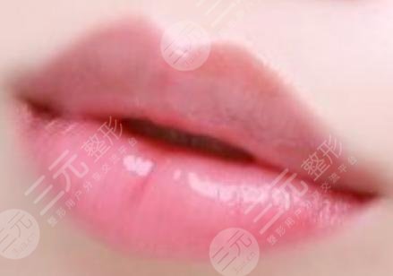 胶原蛋白丰唇的优势特性主要优势为