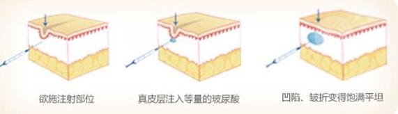 注射玻尿酸丰下巴的果如何