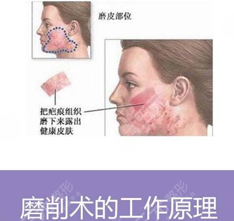 痤疮瘢痕的缓解方法有哪些