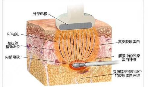 威塑抽脂和水动力吸脂的原理不一样