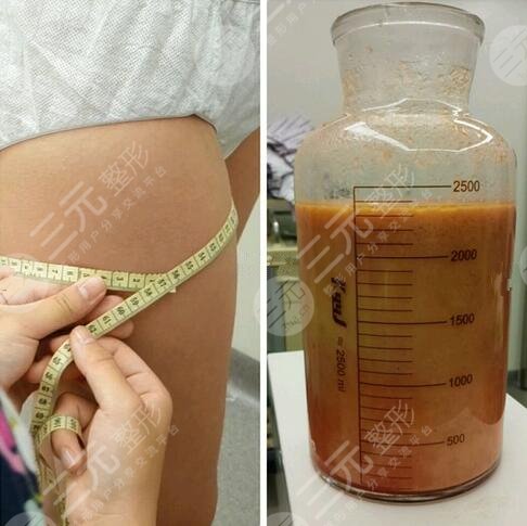 威塑抽脂和水动力吸脂相同之处