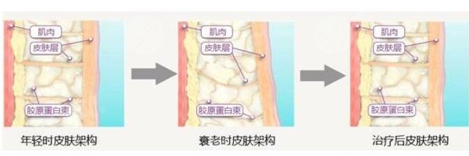 胶原蛋白祛皱价原理是什么