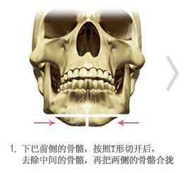 下颌骨截骨手术费用