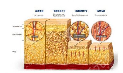 威塑吸脂和黄金微雕的区别