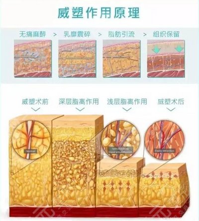 威塑吸脂恢复期要多久