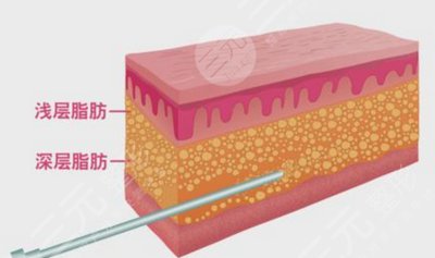 威塑吸脂恢复期要多久