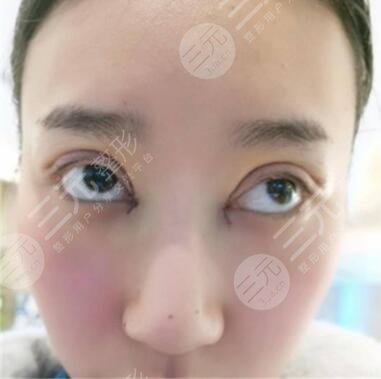 双眼皮的手术过程
