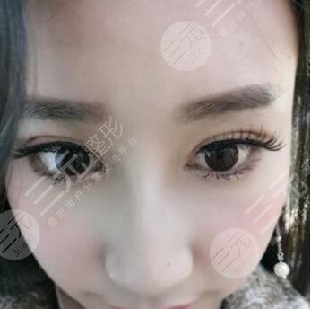 双眼皮的手术过程