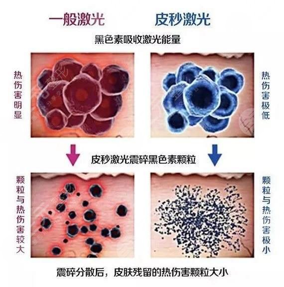 祛斑